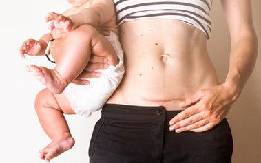 What to Expect: A Guide to Physical Recovery After Cesarean Birth